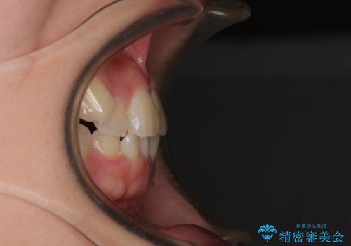 八重歯を治す 非抜歯のワイヤー矯正治療の治療前