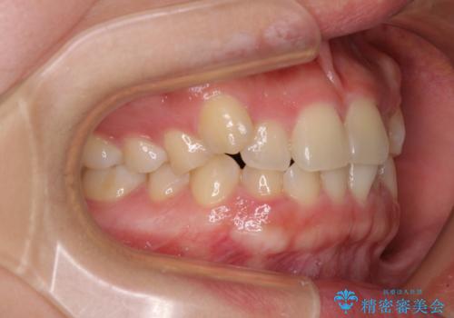 八重歯を治す 非抜歯のワイヤー矯正治療の治療前