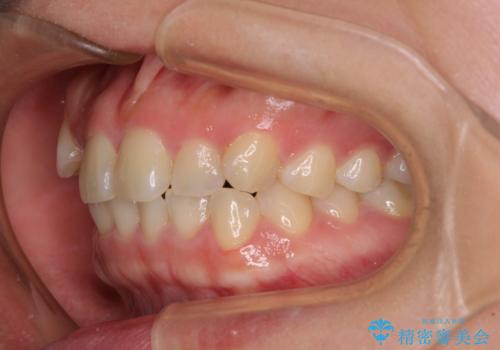 八重歯を治す 非抜歯のワイヤー矯正治療の治療前