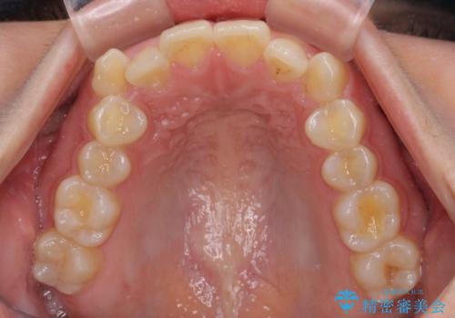 八重歯を治す　非抜歯のワイヤー矯正治療の治療前
