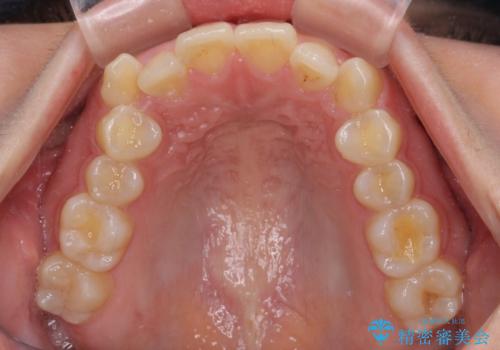 八重歯を治す 非抜歯のワイヤー矯正治療の治療前