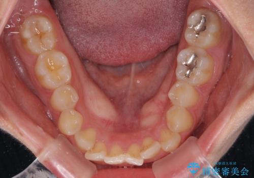 八重歯を治す 非抜歯のワイヤー矯正治療の治療前