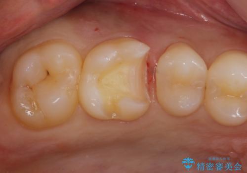 銀歯を白くしたい。の治療中