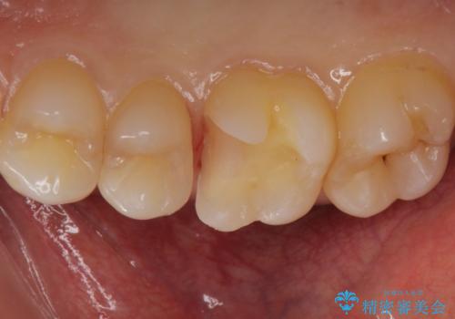 銀歯を白くしたい。の治療中
