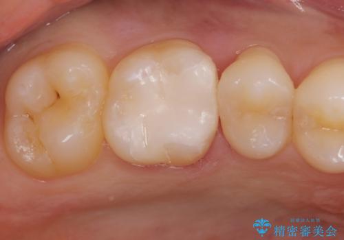 銀歯を白くしたい。の治療後