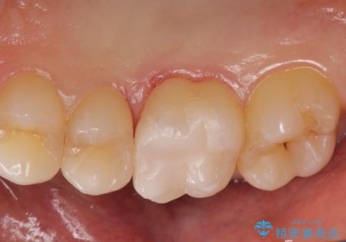 銀歯を白くしたい。の治療後