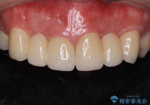 前歯が気になる。ブリッジによる治療。の治療後