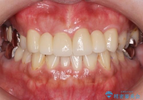 前歯が気になる。ブリッジによる治療。の治療後