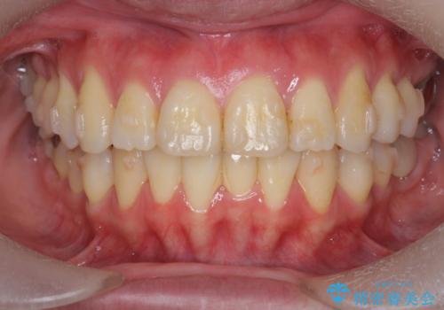 捻れた奥歯 突き出た前歯を治したいの治療中