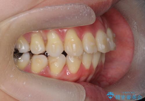 捻れた奥歯 突き出た前歯を治したいの治療中