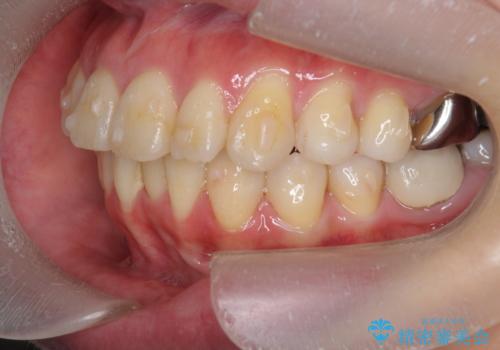 捻れた奥歯 突き出た前歯を治したいの治療中