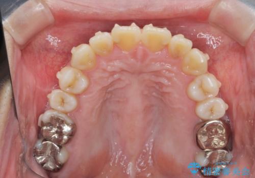 捻れた奥歯 突き出た前歯を治したいの治療中