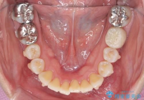 捻れた奥歯 突き出た前歯を治したいの治療中