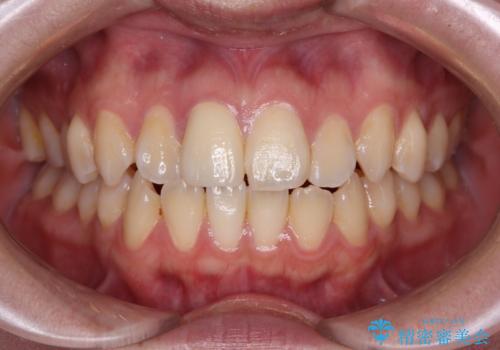 違和感のある前歯をセラミックにしたいの症例 治療後