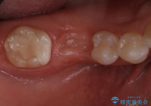 『インプラント』主訴:歯を入れたいの症例 治療前