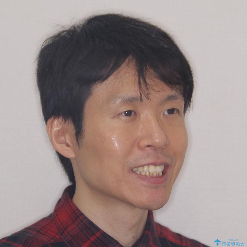 【モニター】口が閉じにくい 抜歯矯正でスッキリした口元にの治療前(顔貌)