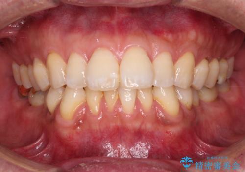 【モニター】口が閉じにくい 抜歯矯正でスッキリした口元にの症例 治療前