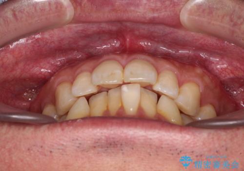 【モニター】口が閉じにくい 抜歯矯正でスッキリした口元にの治療前