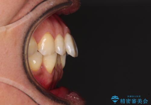 【モニター】口が閉じにくい 抜歯矯正でスッキリした口元にの治療前