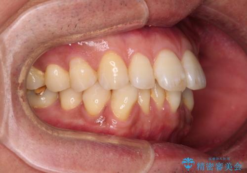 【モニター】口が閉じにくい 抜歯矯正でスッキリした口元にの治療前