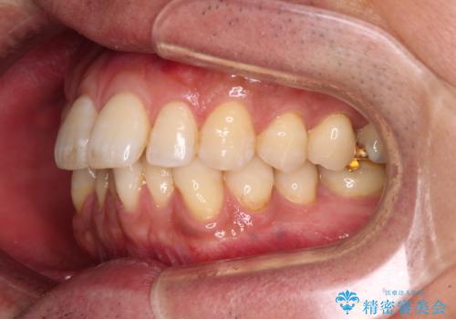 【モニター】口が閉じにくい 抜歯矯正でスッキリした口元にの治療前