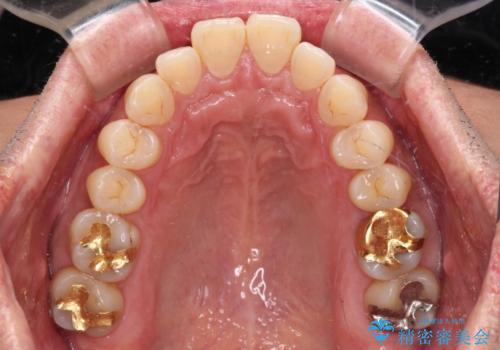 【モニター】口が閉じにくい 抜歯矯正でスッキリした口元にの治療前