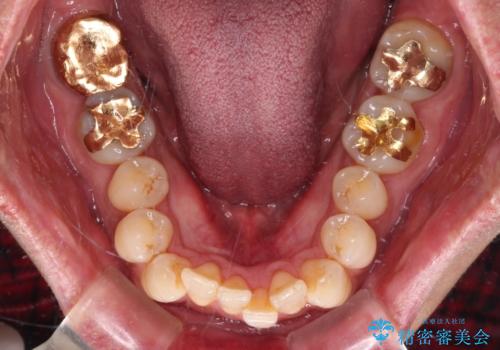 【モニター】口が閉じにくい 抜歯矯正でスッキリした口元にの治療前