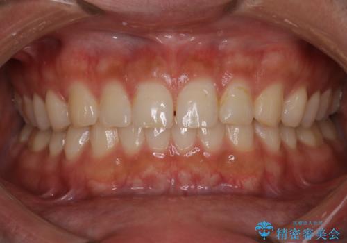 【インビザライン】正中離開を治したい