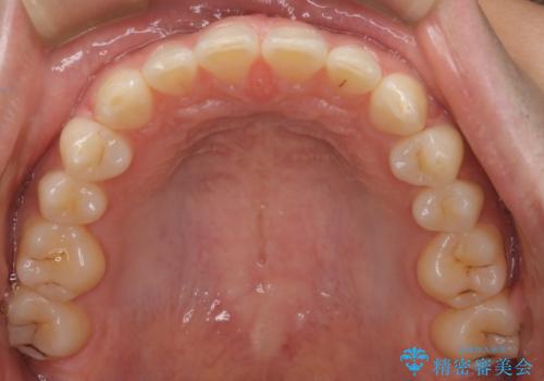 【インビザライン】正中離開を治したいの治療前