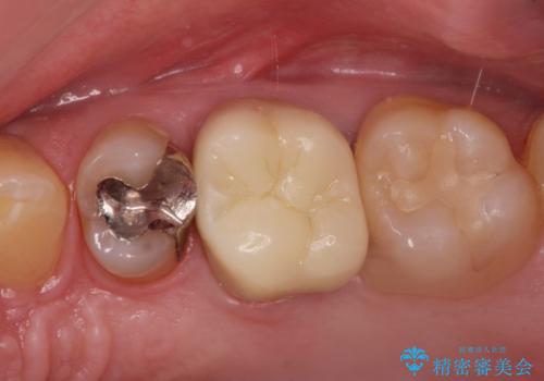 銀歯を白くしたい・・の症例 治療後