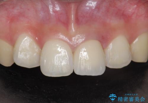 前歯をやりかえたい。の症例 治療後