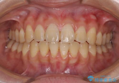 舌の突出癖による開咬と前歯の突出 インビザライン矯正治療の治療中