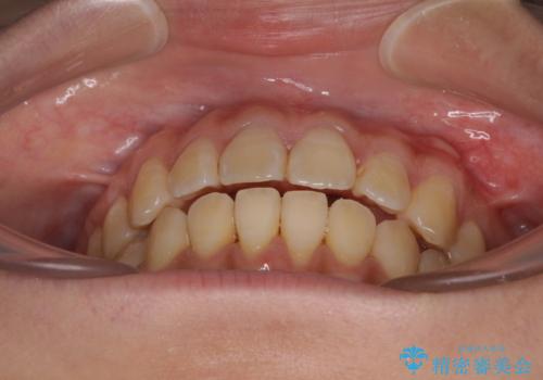 舌の突出癖による開咬と前歯の突出 インビザライン矯正治療の治療中