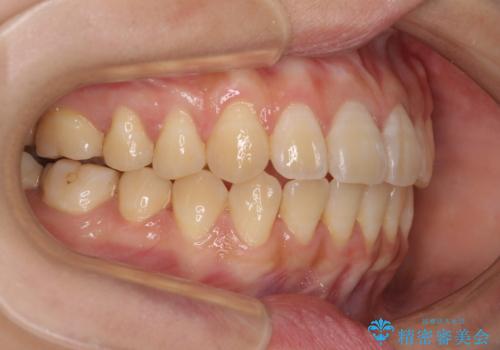 舌の突出癖による開咬と前歯の突出 インビザライン矯正治療の治療中