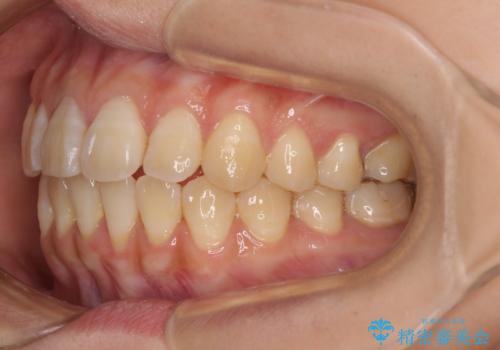 舌の突出癖による開咬と前歯の突出 インビザライン矯正治療の治療中