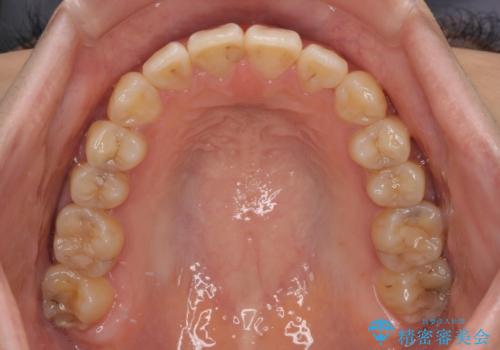 舌の突出癖による開咬と前歯の突出 インビザライン矯正治療の治療中