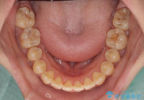 舌の突出癖による開咬と前歯の突出 インビザライン矯正治療の治療中