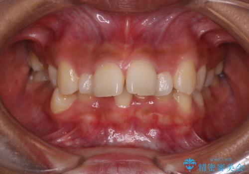 凸凹を綺麗にしたい。表側ワイヤー矯正の症例 治療前