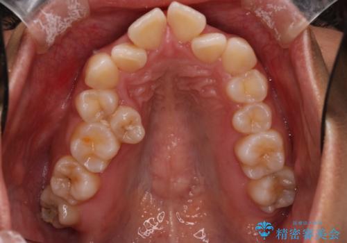 凸凹を綺麗にしたい。表側ワイヤー矯正の治療前