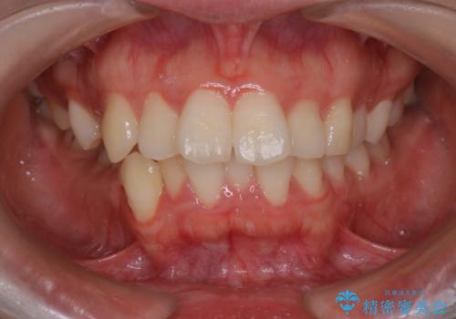 【抜歯インビザ】凸凹を綺麗になおしたいの治療前