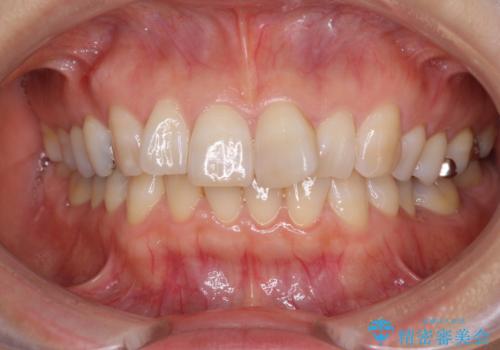 インビザラインが続けられない 忍耐のマウスピース矯正の治療前