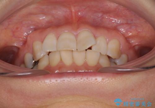 インビザラインが続けられない 忍耐のマウスピース矯正の治療前