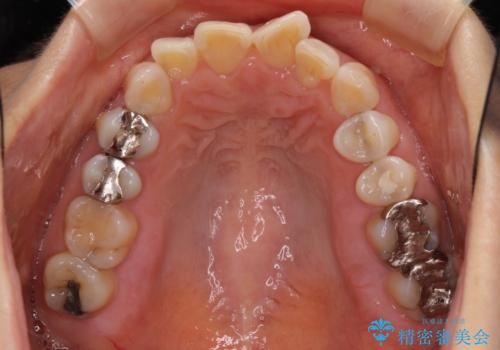 インビザラインが続けられない 忍耐のマウスピース矯正の治療前