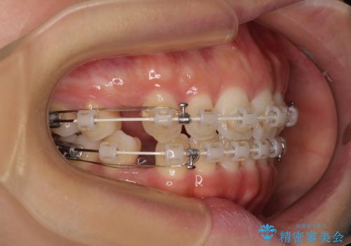 閉じにくい口元をワイヤー抜歯矯正でスッキリした口元にの治療中