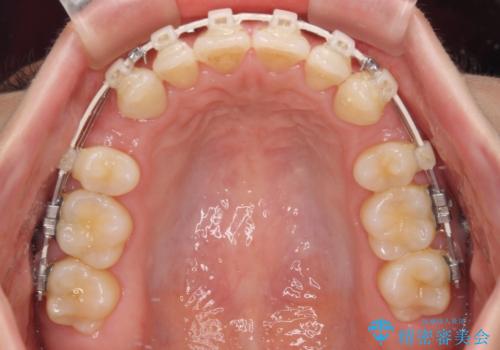 閉じにくい口元をワイヤー抜歯矯正でスッキリした口元にの治療中