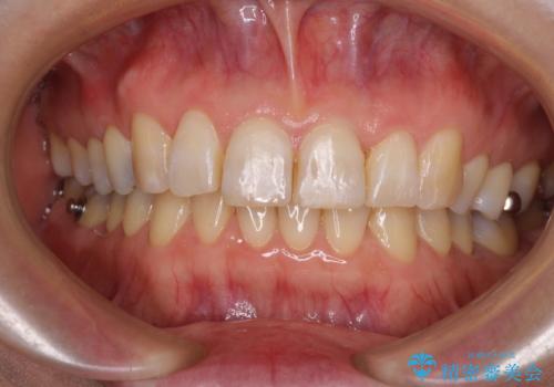 インビザラインが続けられない 忍耐のマウスピース矯正