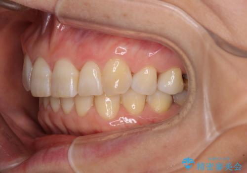 インビザラインが続けられない 忍耐のマウスピース矯正の治療後