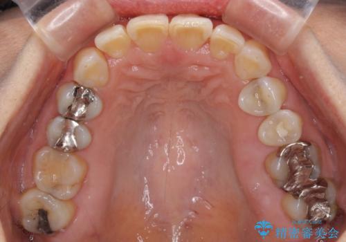 インビザラインが続けられない　忍耐のマウスピース矯正の治療後