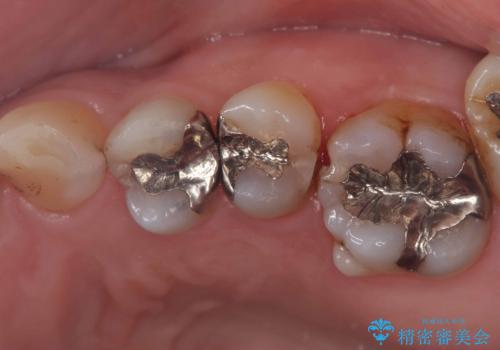 【オールセラミッククラウン】虫歯治療!再治療を減らす治療!の症例 治療前