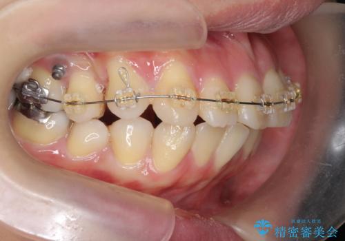 捻れた奥歯 突き出た前歯を治したいの治療中
